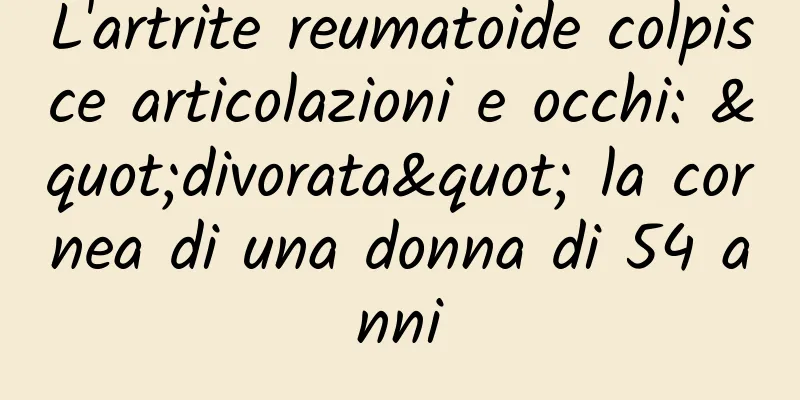 L'artrite reumatoide colpisce articolazioni e occhi: "divorata" la cornea di una donna di 54 anni