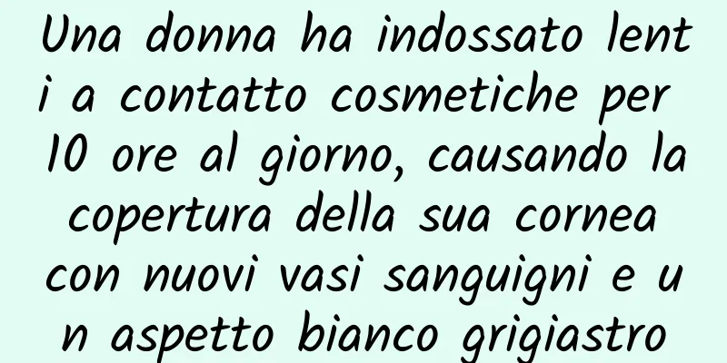 Una donna ha indossato lenti a contatto cosmetiche per 10 ore al giorno, causando la copertura della sua cornea con nuovi vasi sanguigni e un aspetto bianco grigiastro
