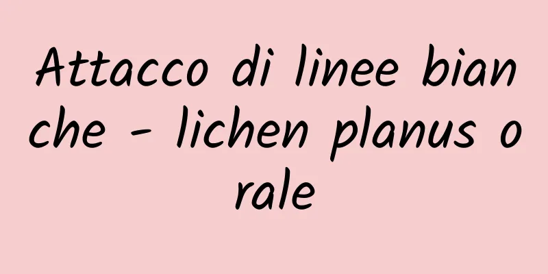 Attacco di linee bianche - lichen planus orale