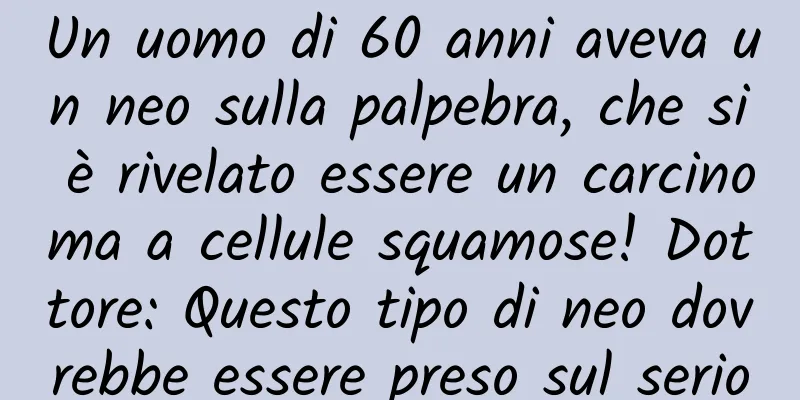Un uomo di 60 anni aveva un neo sulla palpebra, che si è rivelato essere un carcinoma a cellule squamose! Dottore: Questo tipo di neo dovrebbe essere preso sul serio